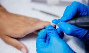 Профессиональная коррекция вросших ногтей и методы лечения